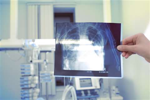 A hand holds up a chest X-ray in a medical setting